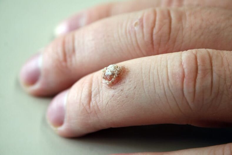 Warts on the finger
