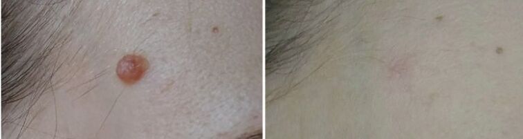 photo before and after laser papilloma removal 2