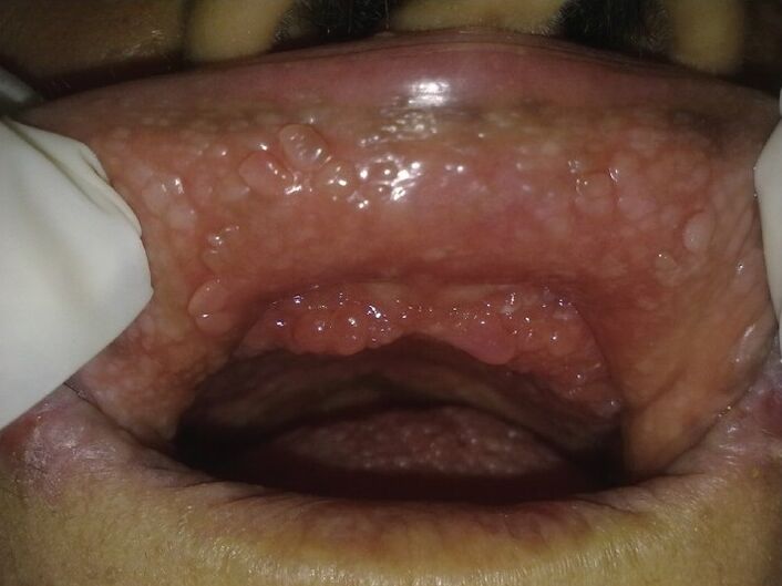 papilloma in the mouth