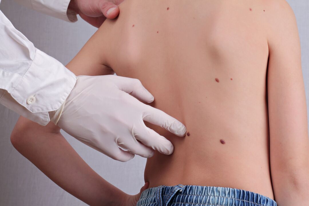 A dermatologist performs a clinical examination of a patient with papilloma on the body