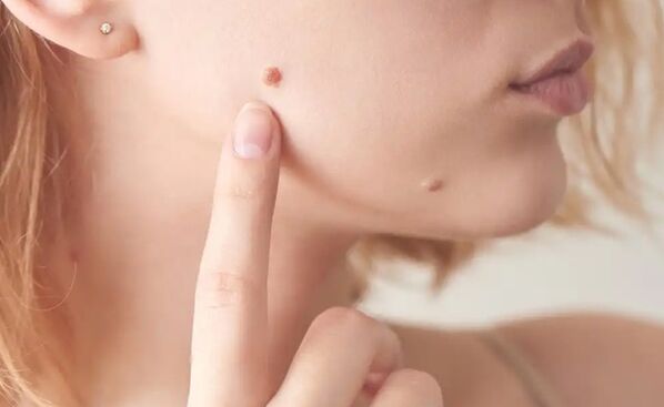 papilloma