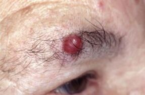 Papilloma in the eyebrows