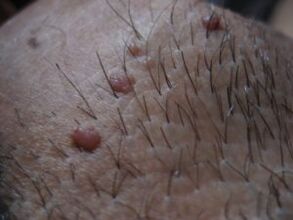 papilloma