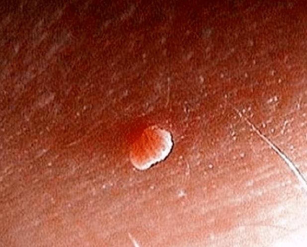Papilloma in the body