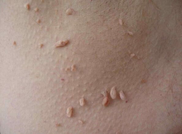 Acrocycies on the skin