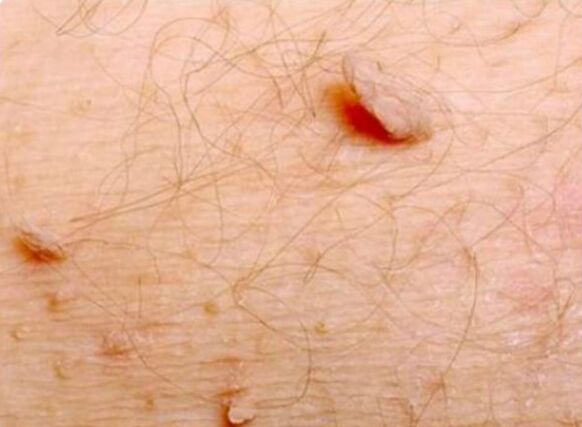 Sharp papillomas in the human body