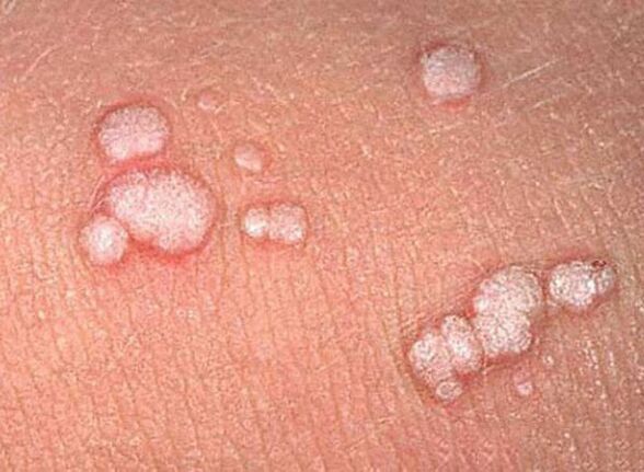 papilloma in the human body