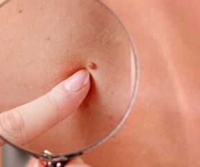 Manifestations of human papilloma virus