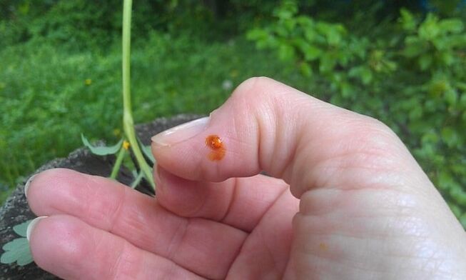 Celandine is applied to the finger