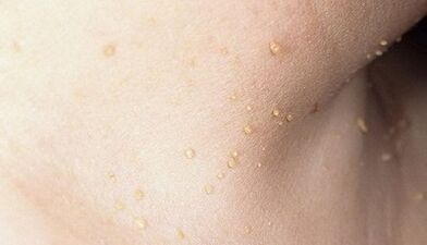 the risk of developing papillomatosis in the neck