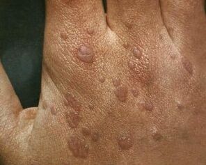 the causes of warts