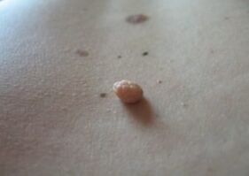 A papilloma is a growth on the surface of the skin