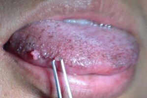 Papilloma on the tongue