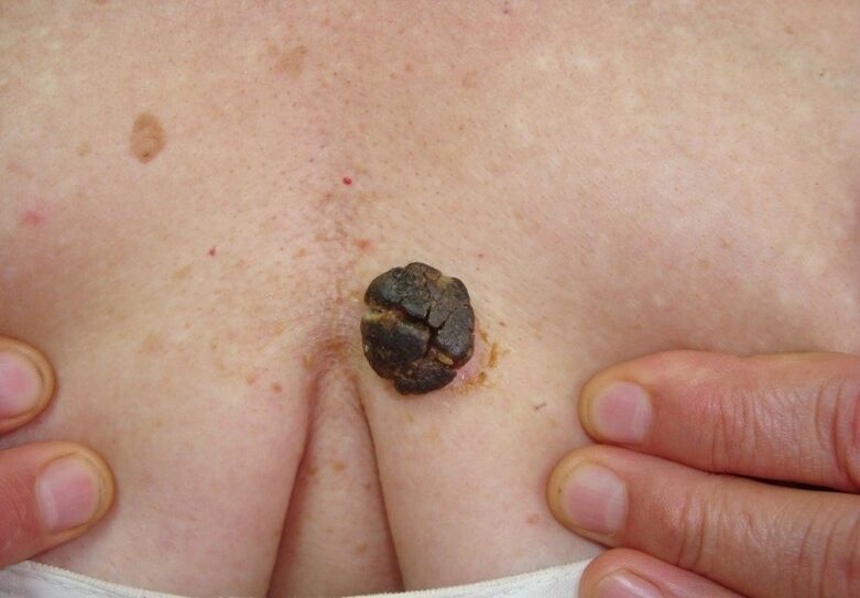 keratoma in the human body