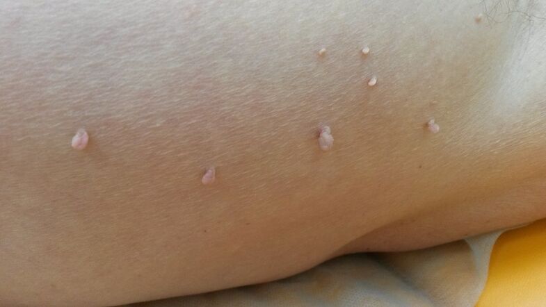 papilloma in the human body