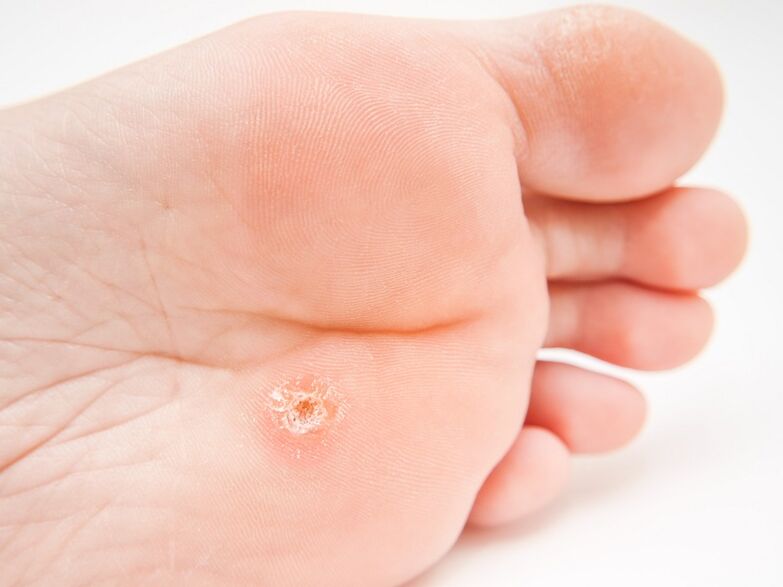 plantar warts on feet