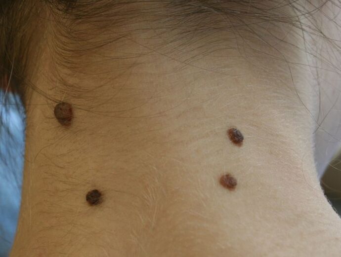 what papillomas look like on the neck