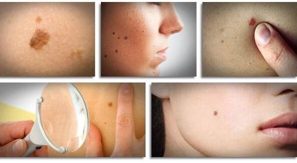 types of viral papillomas in the body