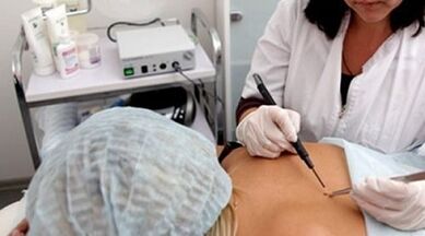 Electrocoagulation as a method of removing warts
