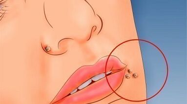 Reasons for presenting warts